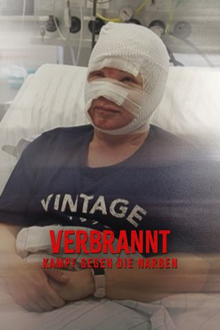 VERBRANNT - Kampf gegen die Narben!